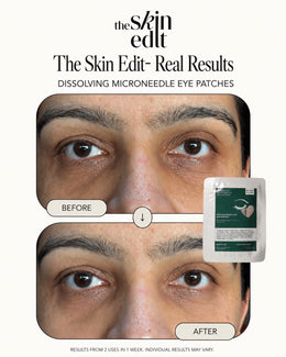 Dissolving Microneedle Eye Patches